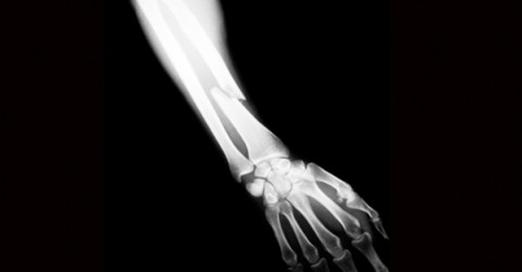 China Report: Osteoporosis