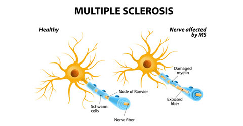 Multiple sclerosis is associated with